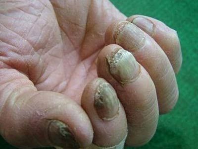 灰指甲的危害【厦门广肤皮肤病专科医院怎么样】